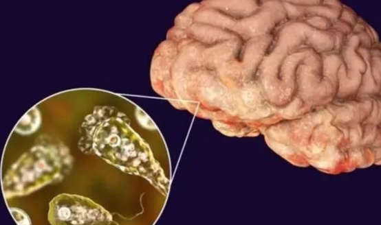 打水仗染食脑虫去世打水仗游戏引发的悲剧，染食脑虫去世
